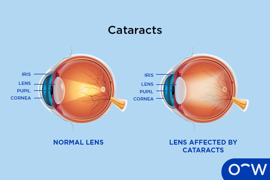 Diagram with a normal lens and a cataract affected lens