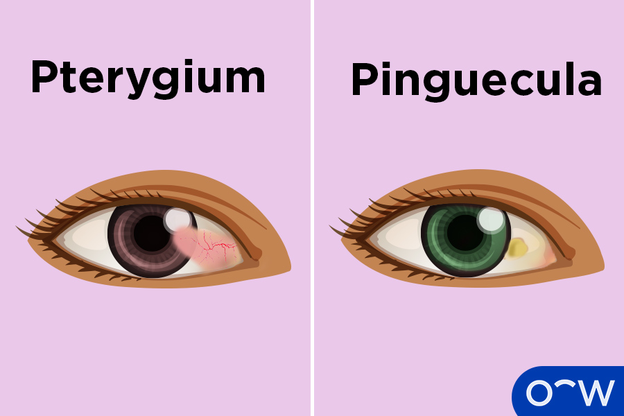 Pterygium Surfer s Eye Causes Symptoms And Treatments