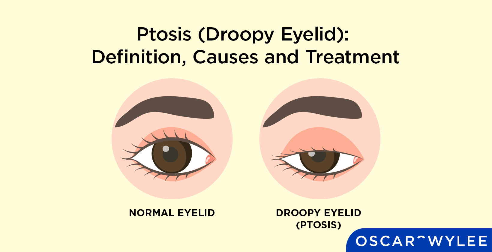 Ptosis (Droopy Eyelid): Definition, Causes and Treatment
