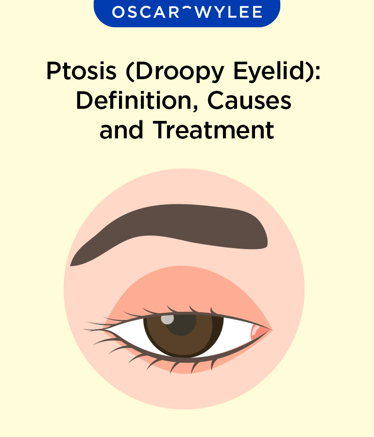 Ptosis (Droopy Eyelid): Definition, Causes and Treatment