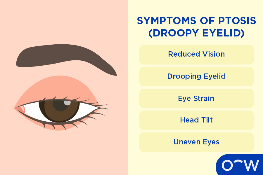 An infographic detailing the symptoms of ptosis.