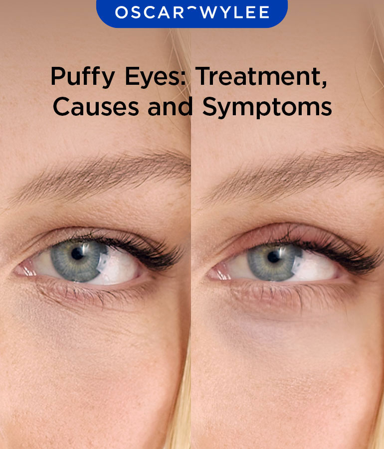 Puffy Eyes: Treatment, Causes and Symptoms
