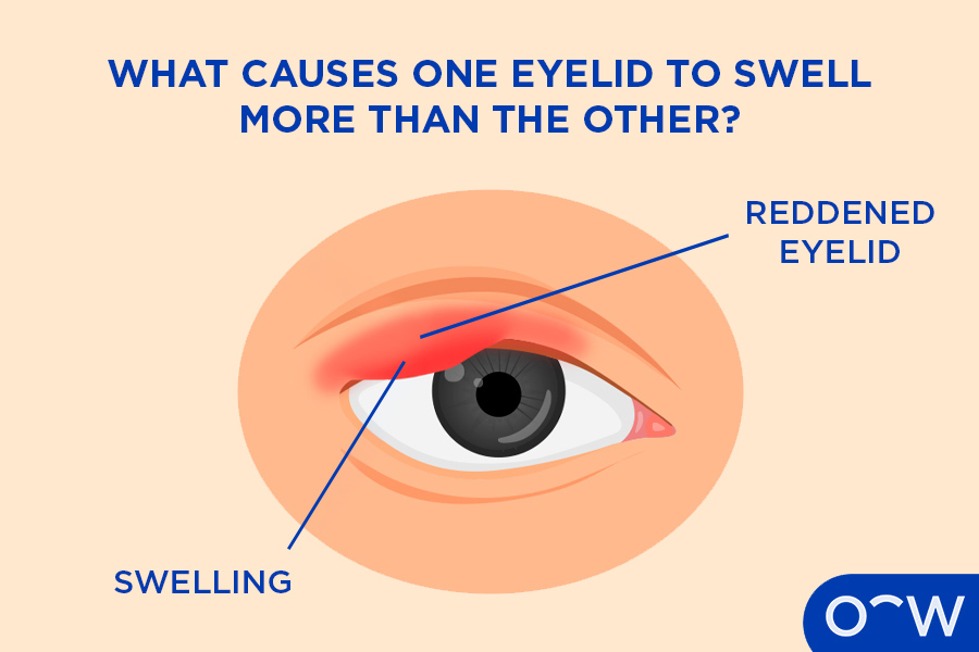 A diagram showing a chalazion, a reason as to why one eyelid may swell more than the other