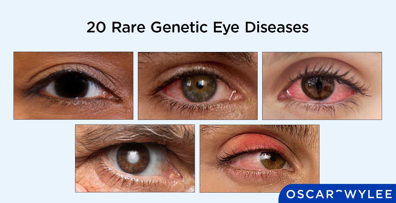 20 Rare Genetic Eye Diseases