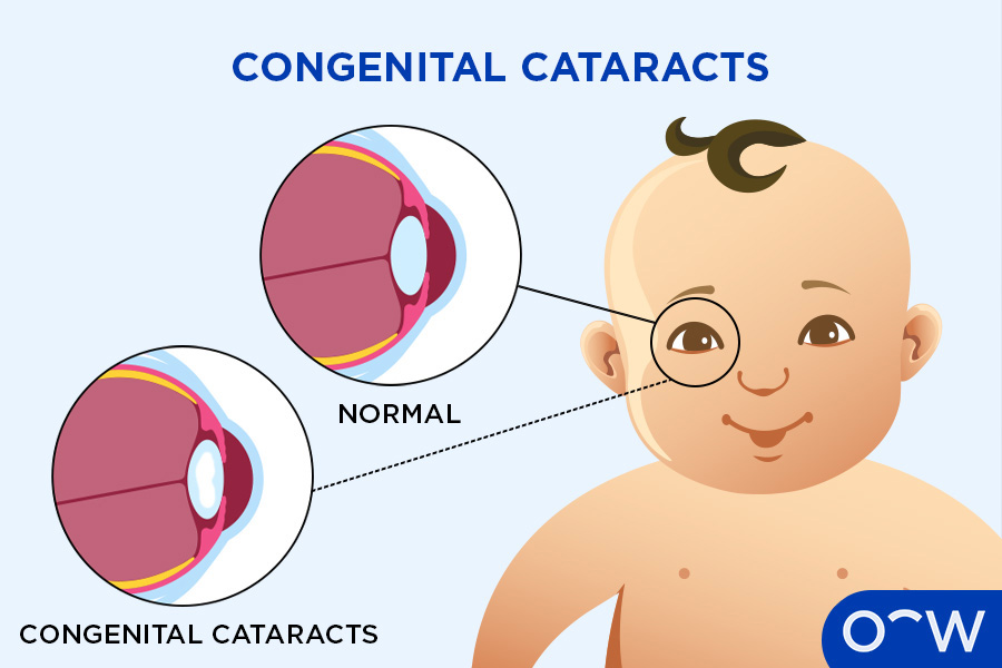 Infographic about congenital cataracts