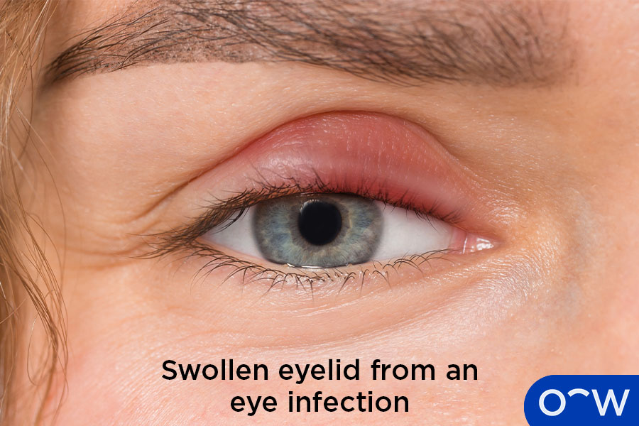 Eye Infections