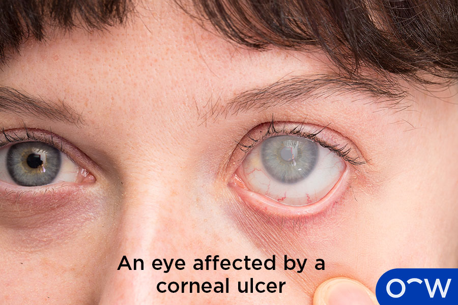 Corneal Ulcer