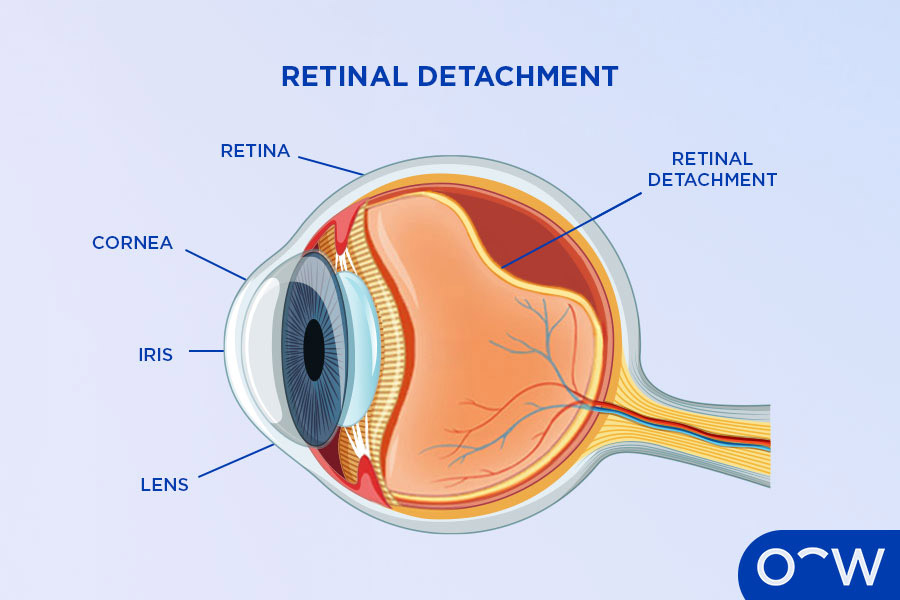 Diagram of retinal detachment, one of the many eye conditions that retinal exams help to look out for.