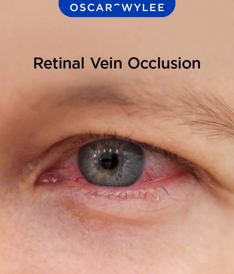 Retinal Vein Occlusion (RVO): Symptoms, Causes and Treatment