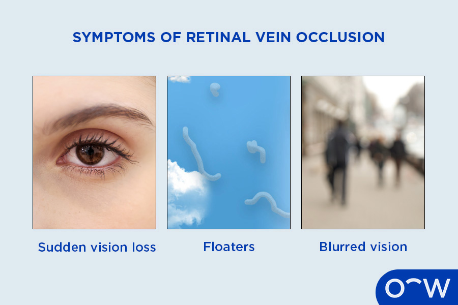 An explainer image of the symptoms of retinal vein occlusion.