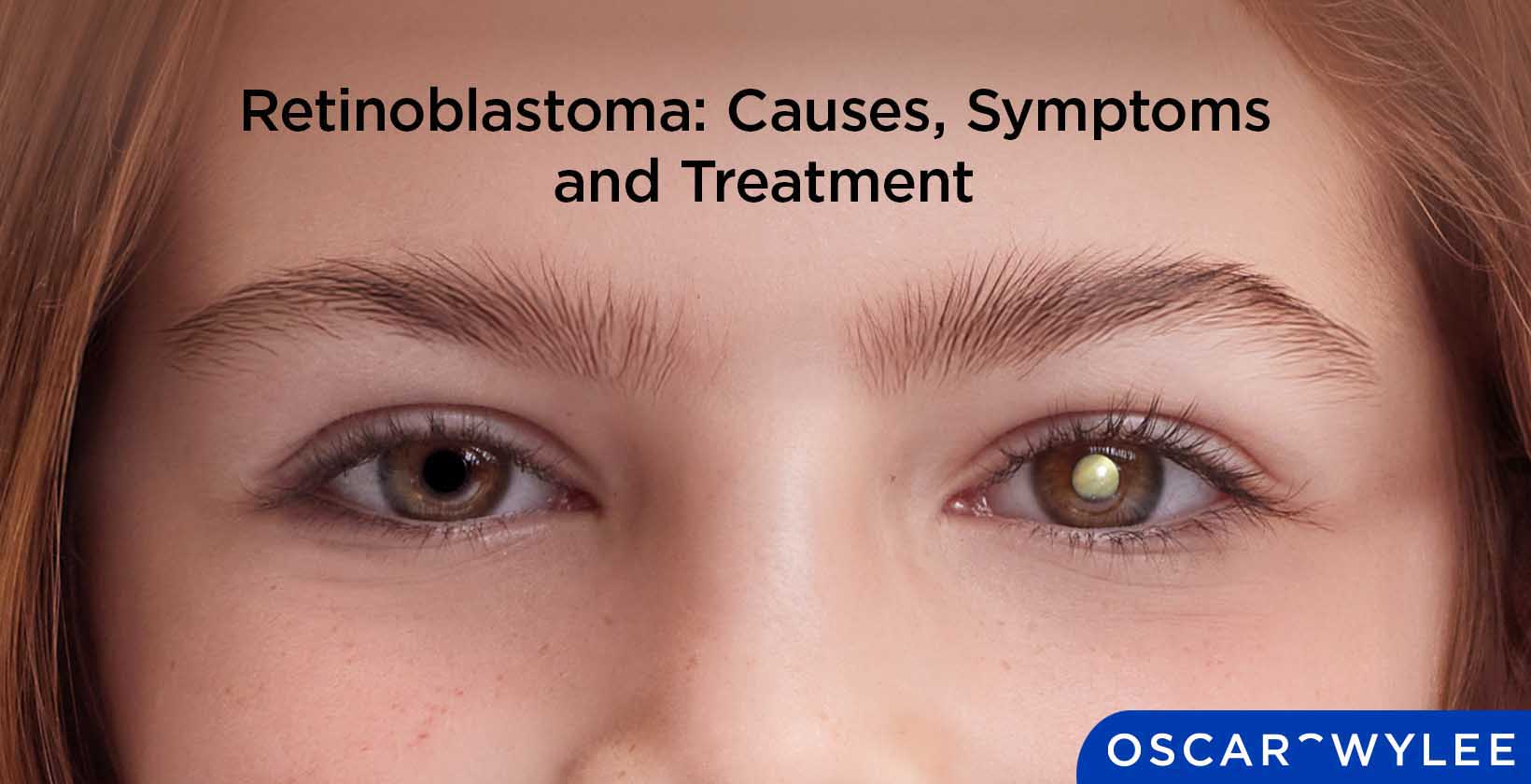 Retinoblastoma: Causes, Symptoms and Treatment