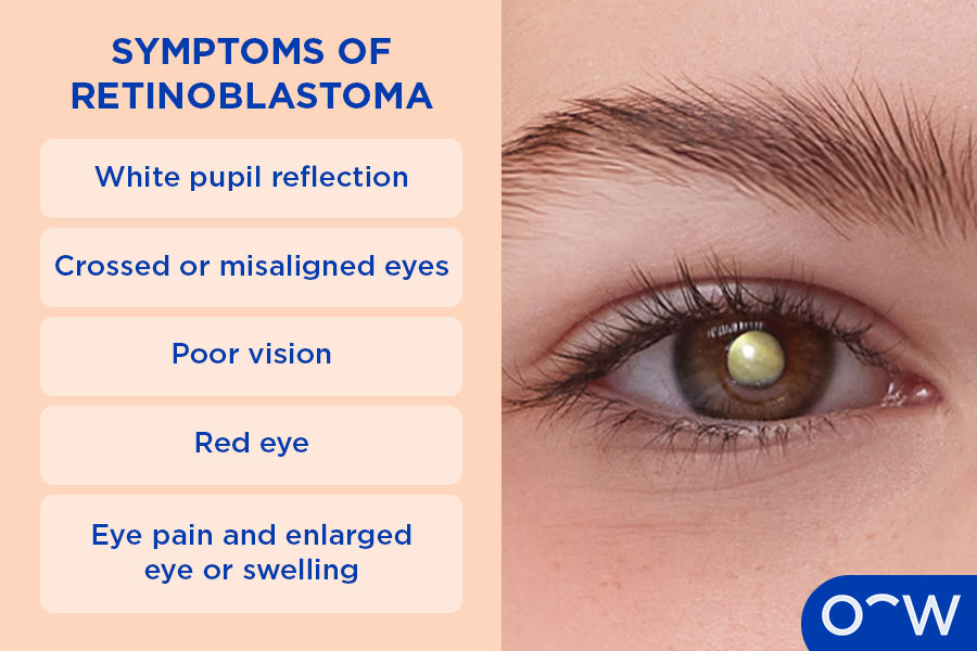 Various graphics depicting the different symptoms of retinoblastoma.