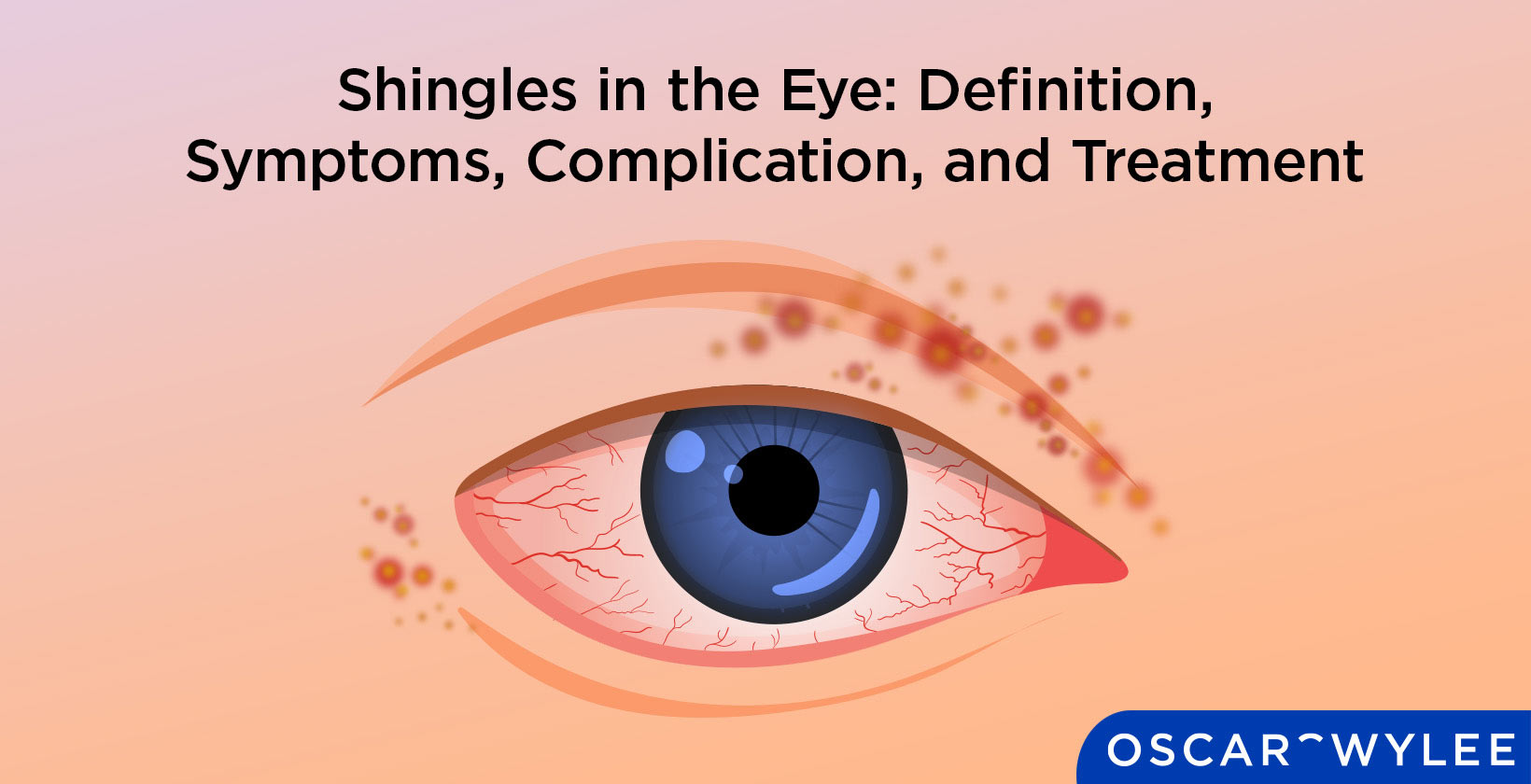 Shingles On The Face Symptoms Treatment And Causes PMJVM
