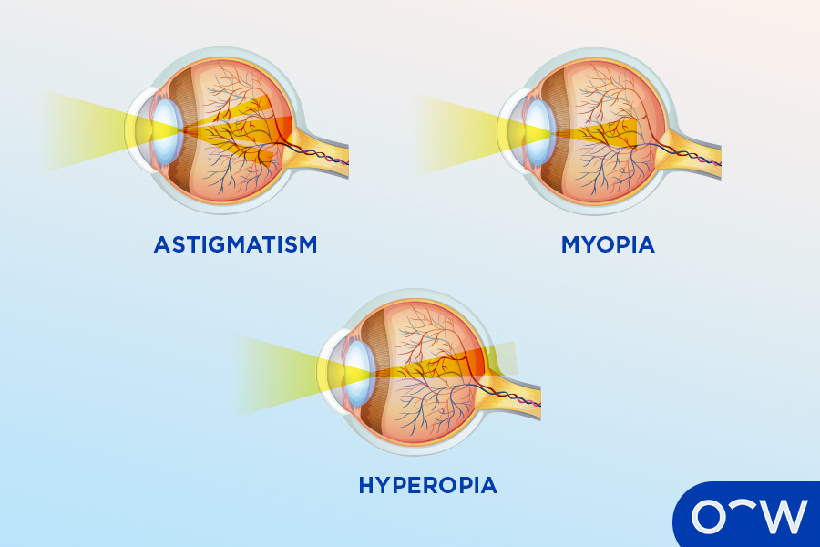 Four eyeballs representing each refractive error, which are
astigmatism, presbyopia, myopia and hyperopia