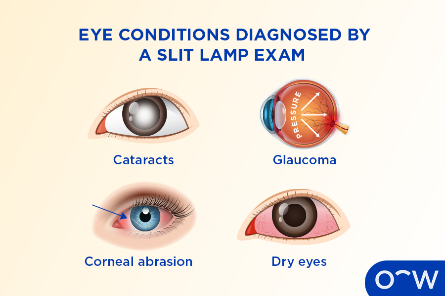 Four eyes representing eye condition that can be detected in a slit lamp exam.