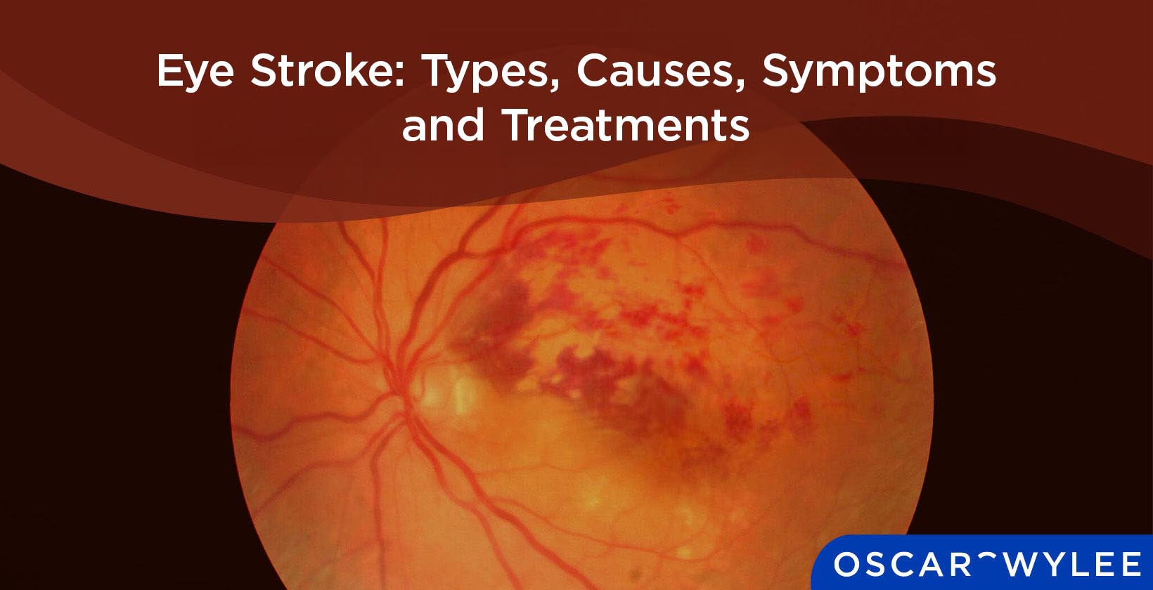Eye Stroke: Types, Causes, Symptoms and Treatments