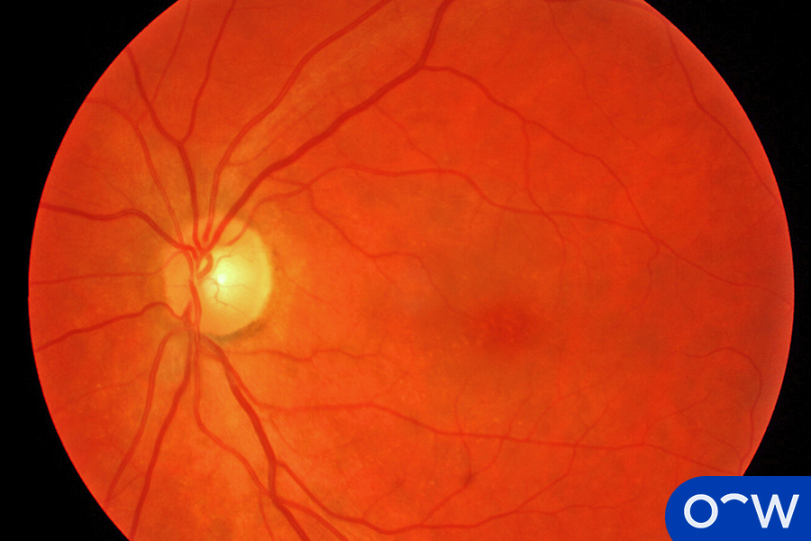 Eye Stroke Types, Symptoms, and Risk Factors