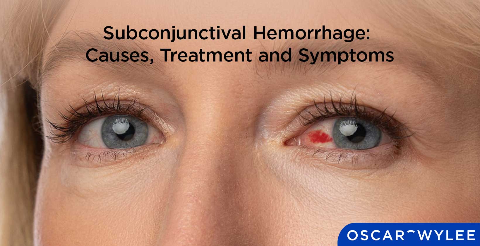 Subconjunctival Hemorrhage: Causes, Treatment and Symptoms