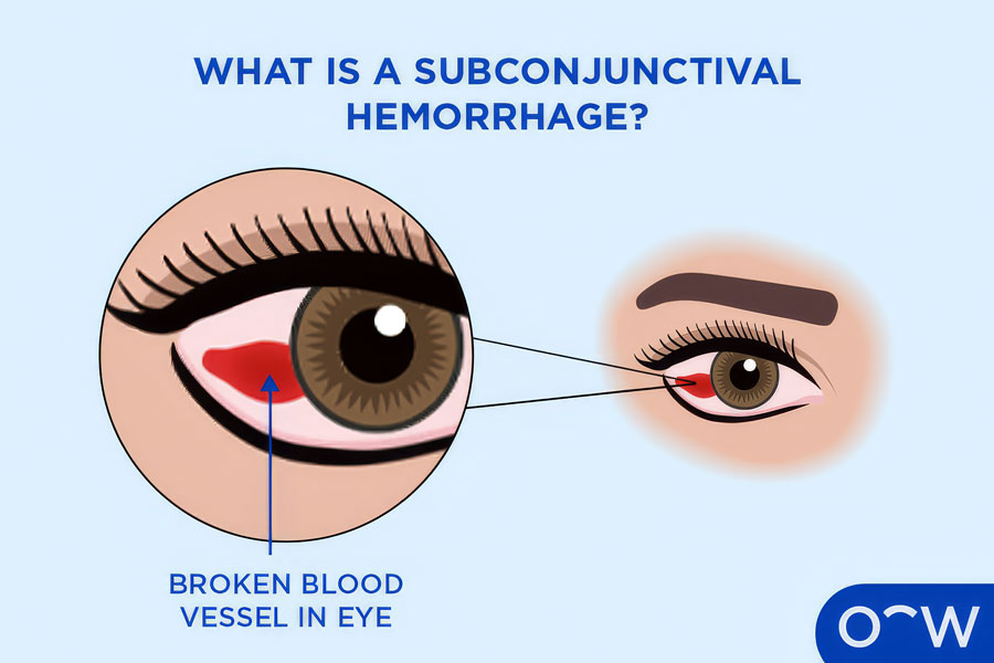 Labelled graphic explaining what a subconjunctival hemorrhage is