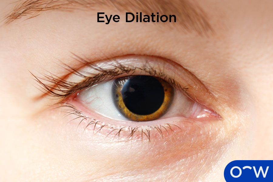A dilated pupil as a result of pupil dilating eye drops.