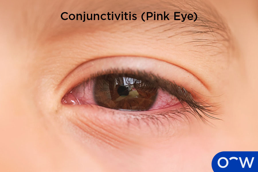 An eye that is red and irritated as a result of conjunctivitis