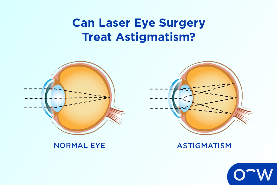 Eye Surgery Definition Types Conditions And Preparation Eye Surgery Definition Types Conditions And Preparation