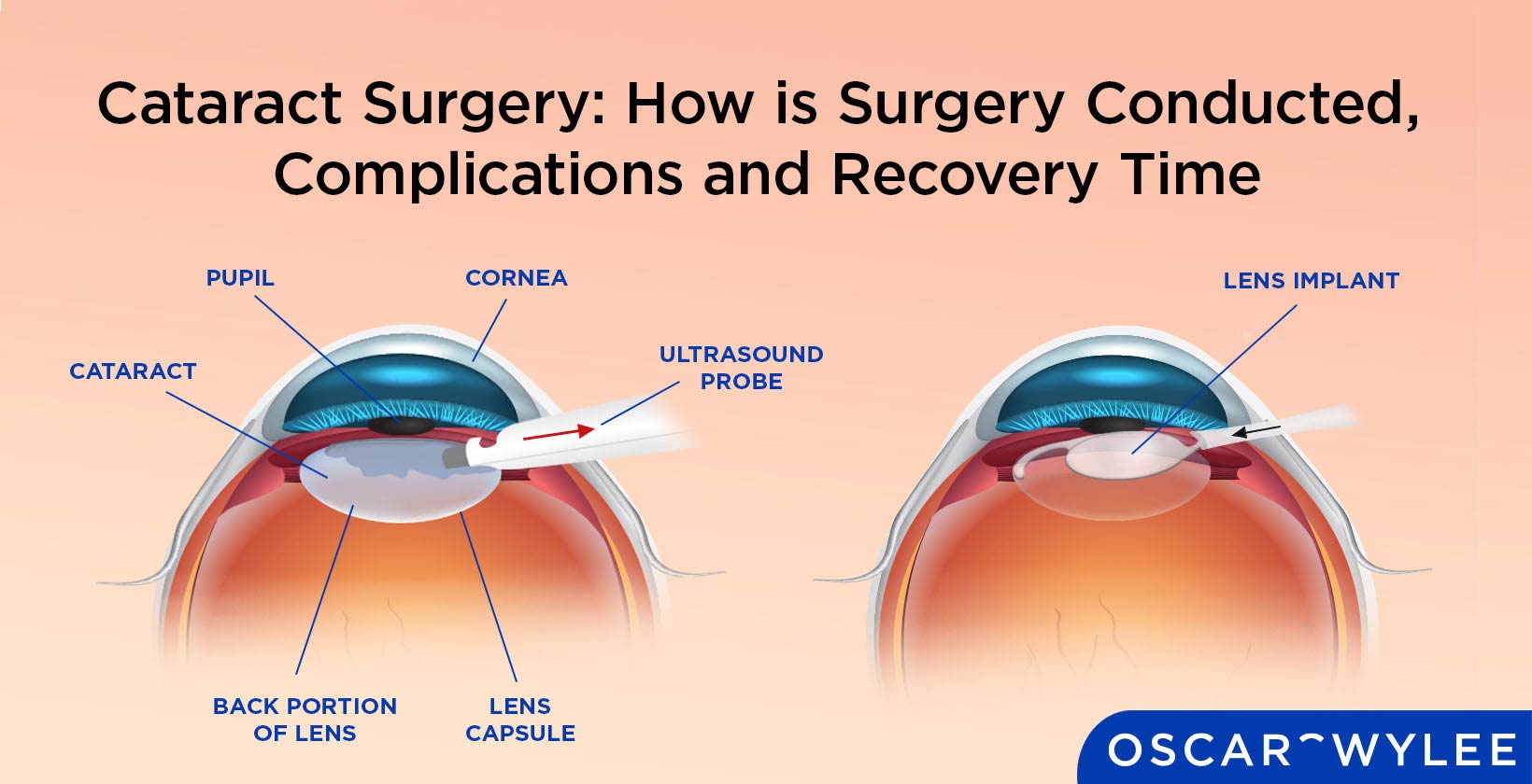 Cataract Surgery