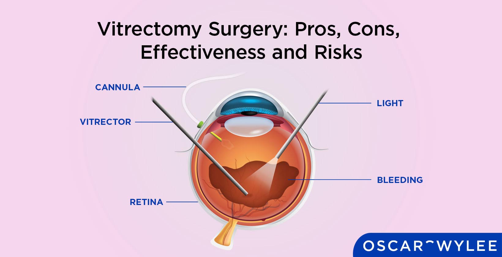 Vitrectomy Surgery