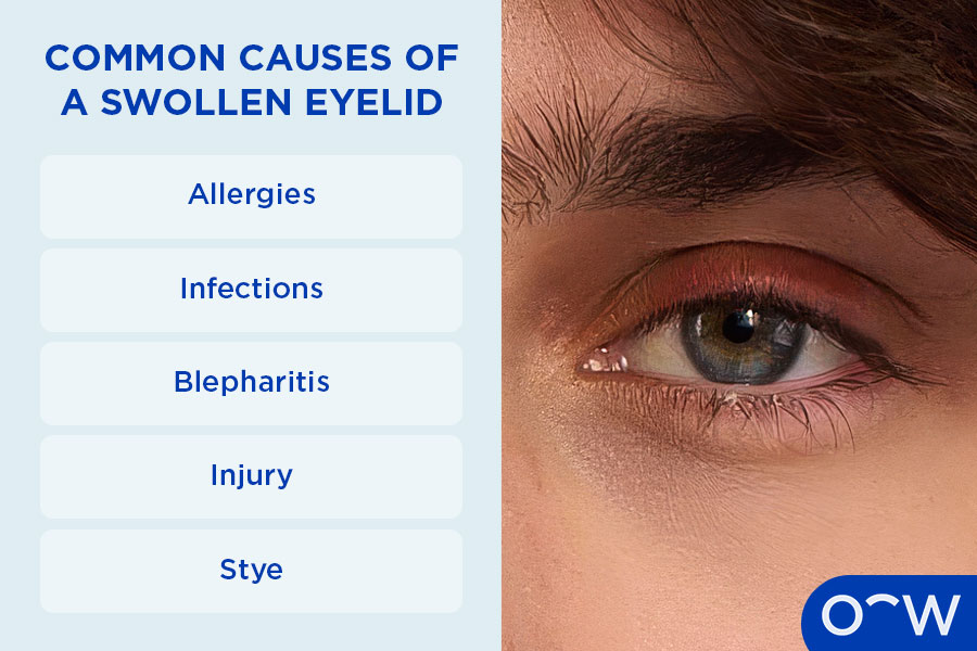 Infographic about the 5 common causes of swollen eyelids: (Allergies, Infections, Blepharitis, Injury, Stye)