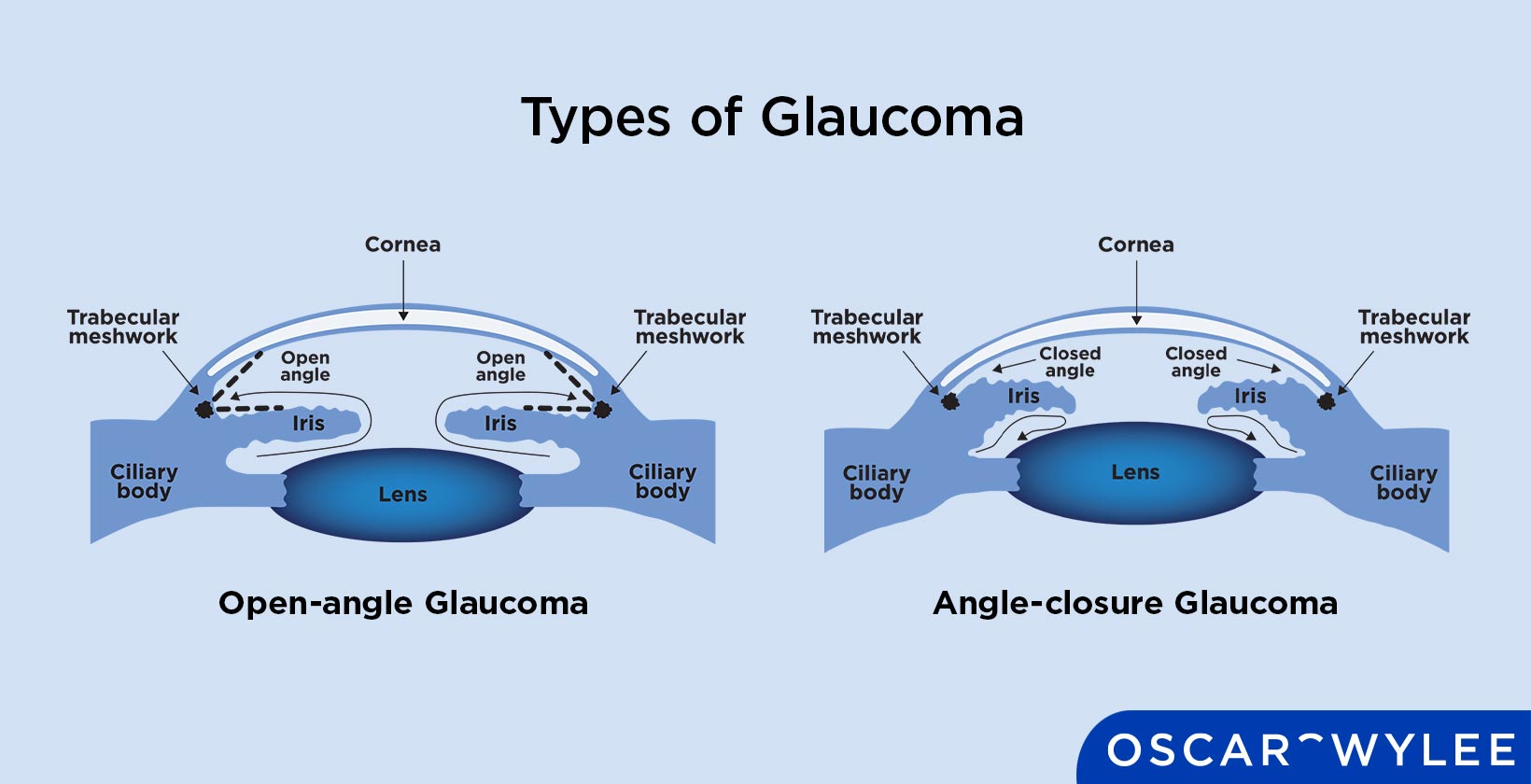 Types of Glaucoma