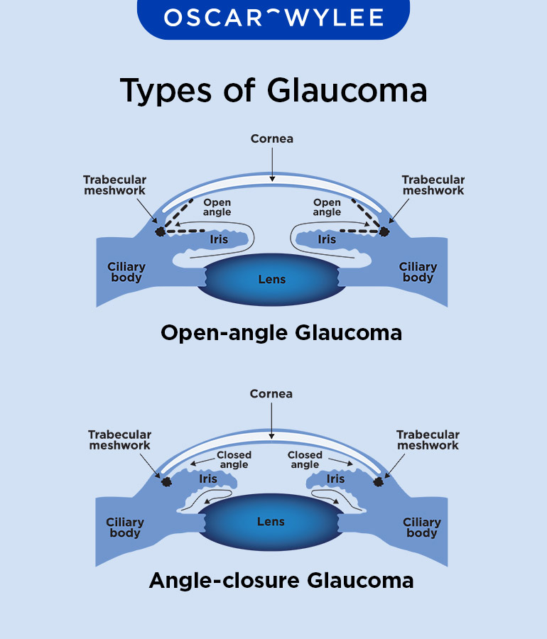 Types of Glaucoma