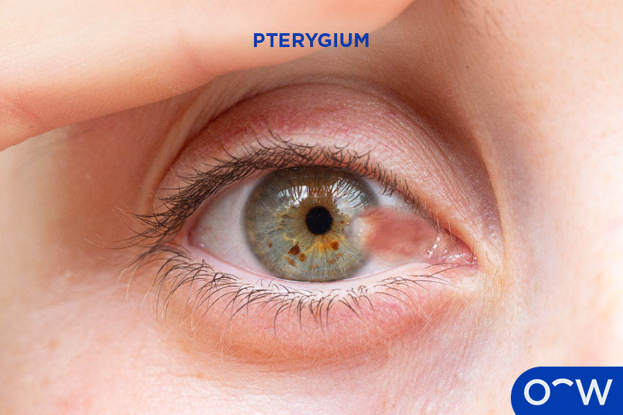 An eye with a fleshy overgrowth on the conjunctiva known as pterygium, caused by long-term exposure to UV light.