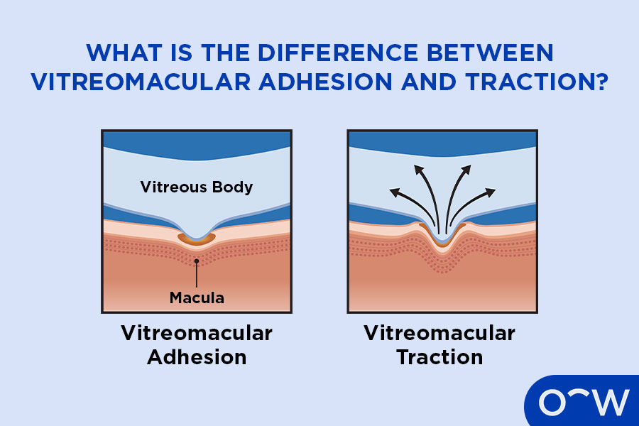 A comparative diagram showing adhesion vs. traction