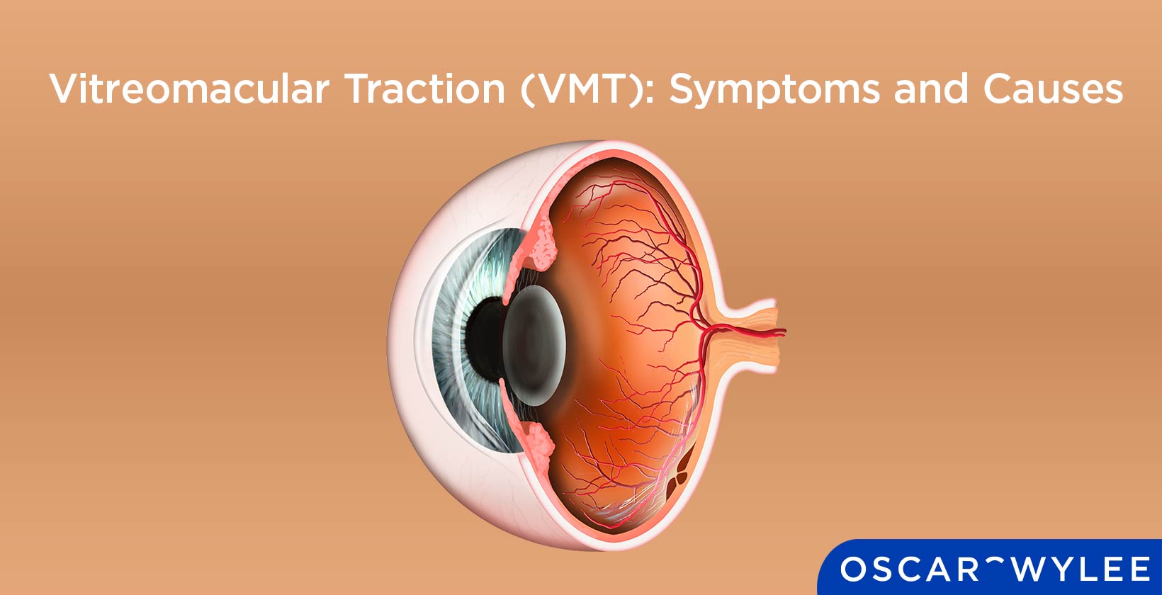 Vitreomacular Traction (VMT): Symptoms and Causes