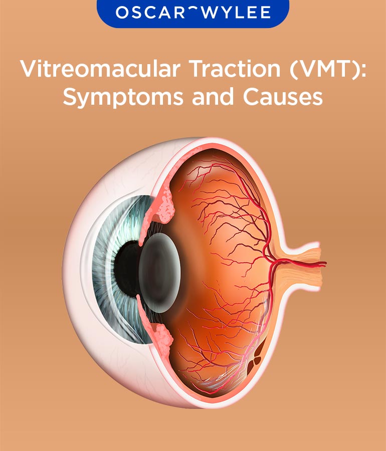 Vitreomacular Traction (VMT): Symptoms and Causes