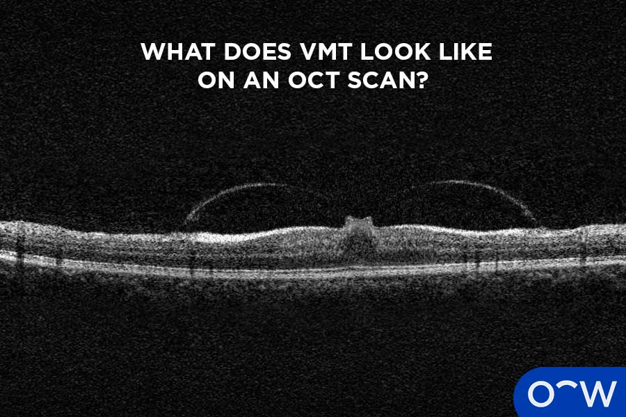 Image of VMT on Optical Coherence Tomography (OCT) scan