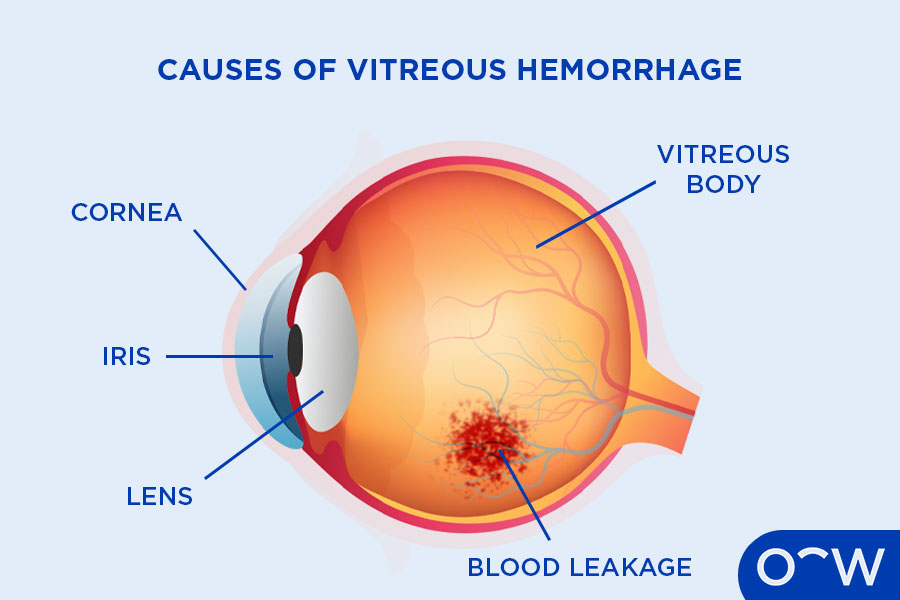 Vitreous Hemorrhage Causes Symptoms And Treatment