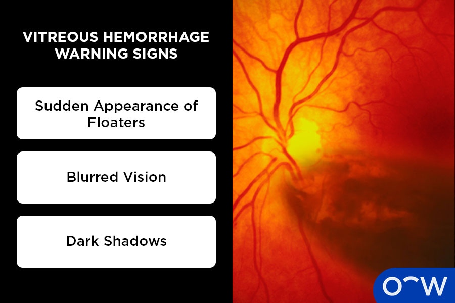 An eye affected by vitreous hemorrhage. 