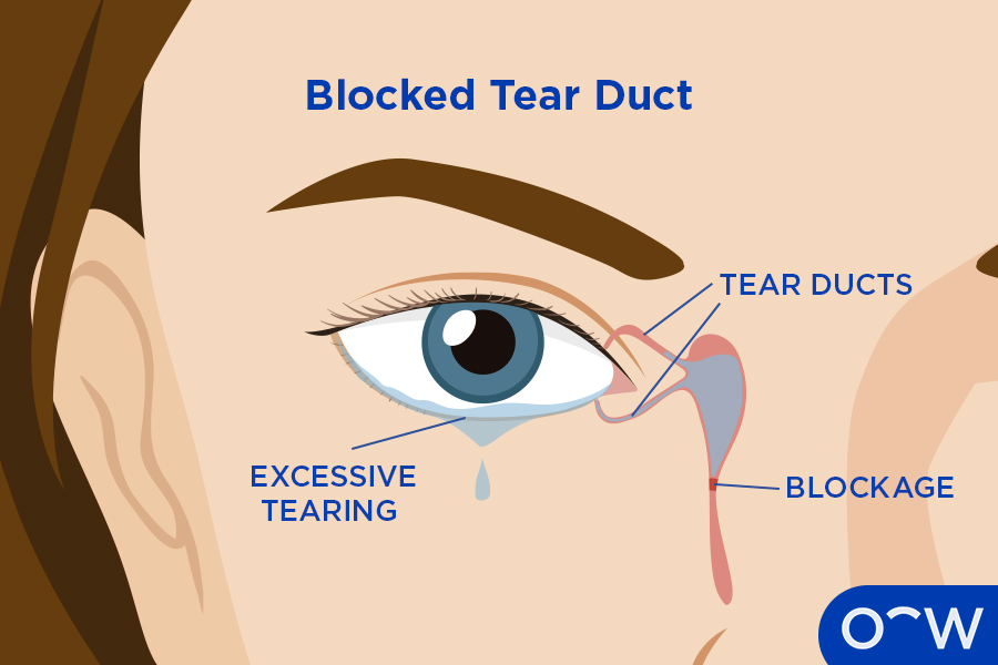 Graphic displaying the anatomy of a blocked tear duct