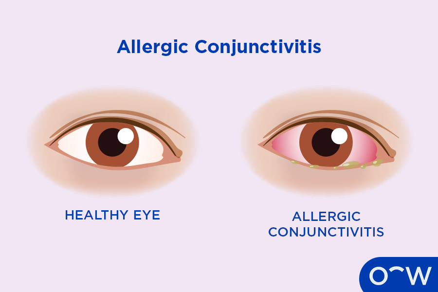 Infographic displaying a healthy eye on the left side and an eye with allergic conjunctivitis on the right side