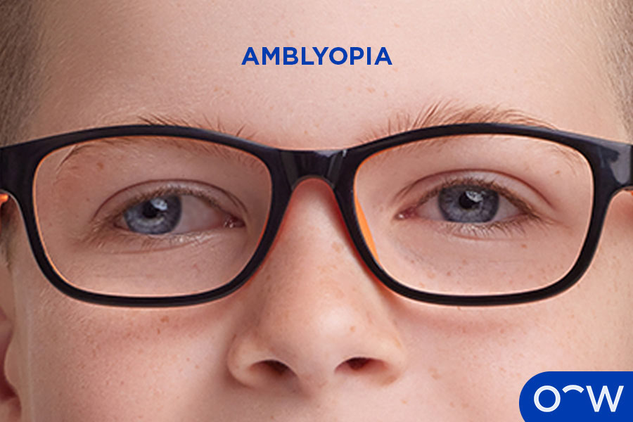 Child’s eyes exhibiting the common eye problem lazy eye (amblyopia)