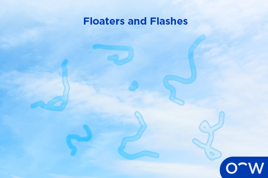 A photo of a blue sky with floaters in view.