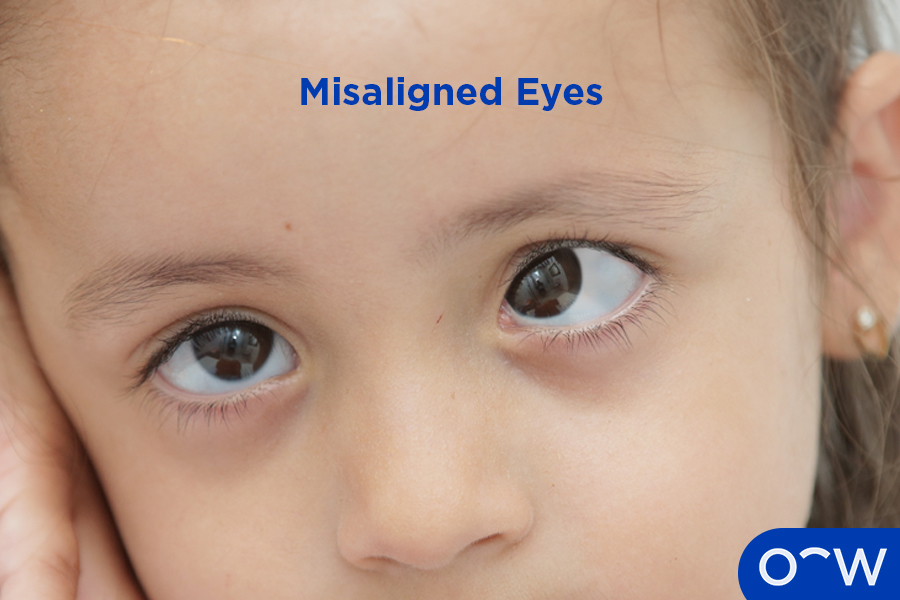 Close-up of child’s misaligned eyes with their left eye positioned inward and their right eye positioned straight ahead.