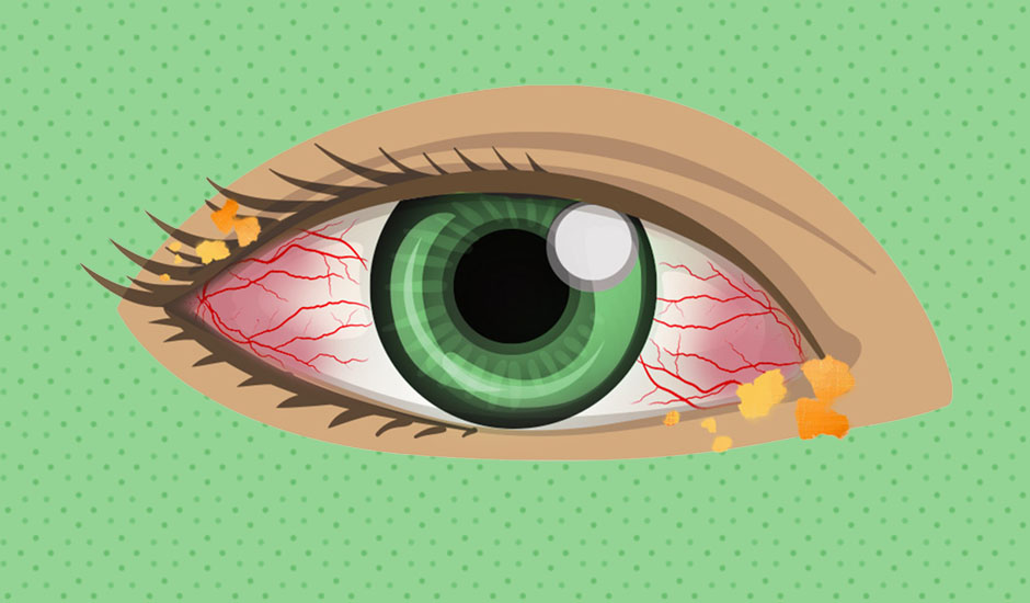 Understanding the Gunk in My Eyes: Causes, Types and Treatments